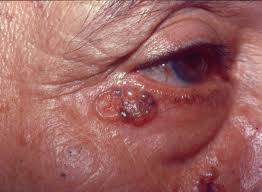 cancer de pele tipo Carcinoma basocelular