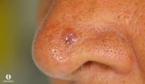 Carcinoma basocelular